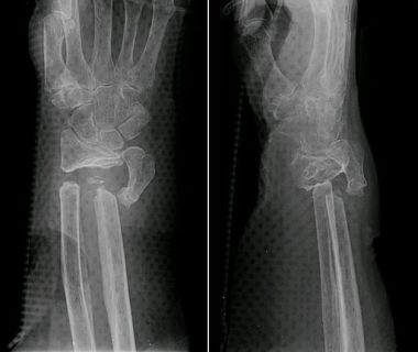 Pseudarthrosis_Wrist_jmn